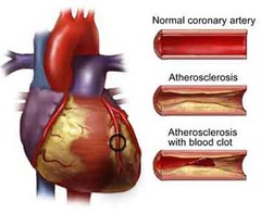 <p>arteriosclerotic cardiovascular disease</p>