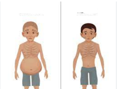 <p>Which malnutirion syndrome that occurs from severe <strong>negative nitrogen balance is being described:</strong></p><ul><li><p>protein-specific deficiency leading to edema, hepatomegaly, and a swollen belly</p></li></ul><p></p>