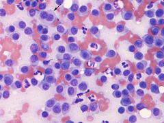 <p>What tumor cell type?v</p>