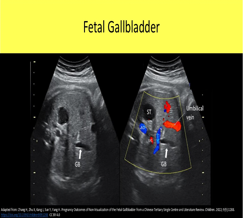 <p>D. The umbilical vein is located centrally in the abdomen while the gallbladder is located to the right between the right and left lobes of the liver.</p><p>The umbilical vein and the gallbladder are usually oriented perpendicular to the abdominal wall. Color Doppler can be used to differentiate the umbilical and liver vasculature from the gallbladder. No color flow will fill the lumen (or the walls) of the gallbladder. The umbilical vein is located centrally in the abdomen while the gallbladder is located to the right between the right and left lobes of the liver.</p>