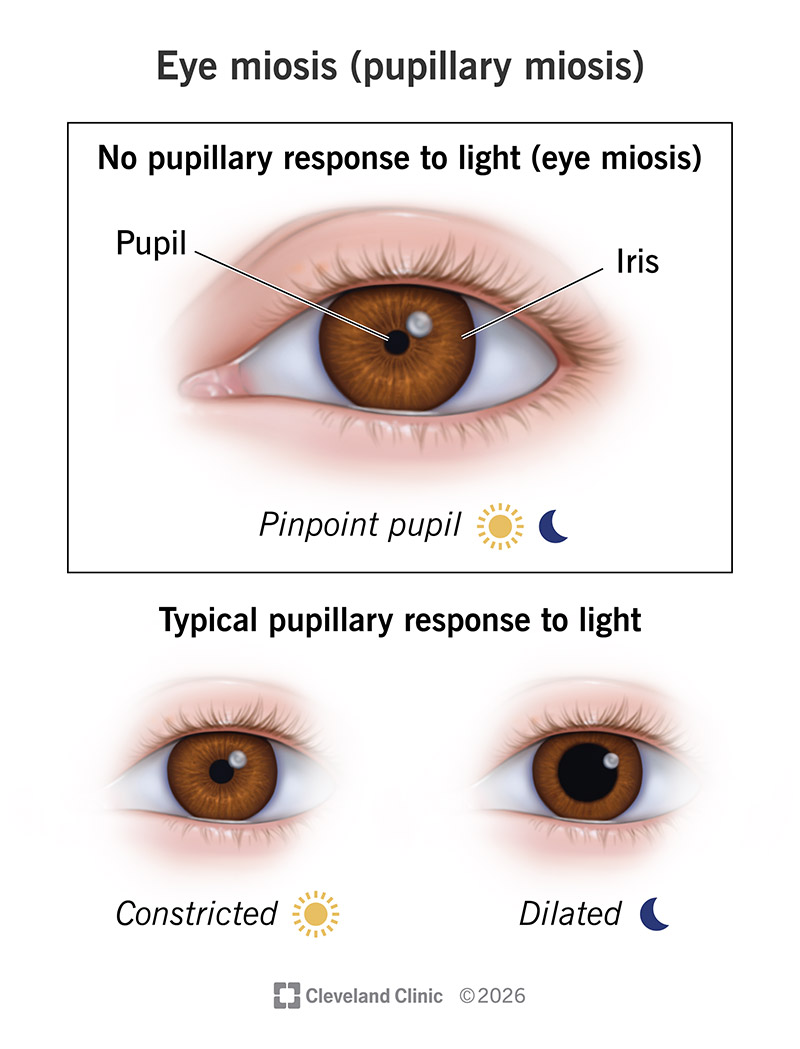 <p>Pupil does not respond to light</p>