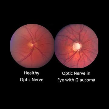 <p>ratio of the width of the physiologic cup to the width of the optic disc normally half or less</p>
