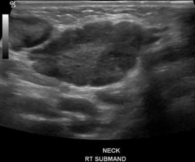 <p>Hypoechoic, rounded shape, absent echogenic hilus, intranodal necrosis (dead cells/breakdown), increasing size of serial exams, and peripheral vascularity. could have lobulated edges</p>
