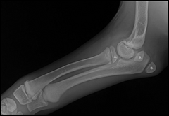 <p>What is A?</p><p>a. proximal radial epiphysis which will become radial head</p><p>b. separate center of ossification for medial epicondyle of the humerus</p><p>c. separate center of ossification of olecranon process</p>