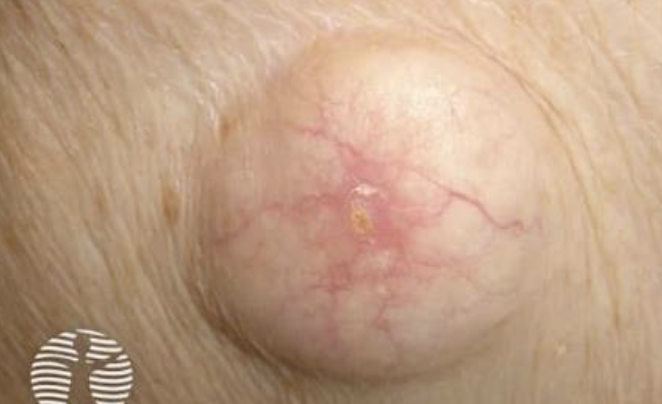 <p>Primary lesion - cyst </p>