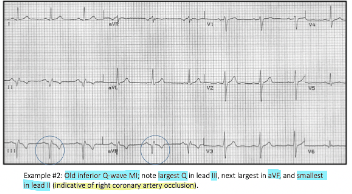 <p>An <strong>old inferior wall MI</strong></p>