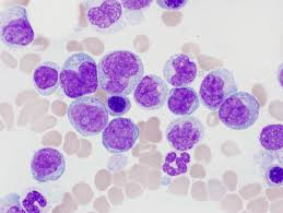 <p>high monocytes</p><p>indicates your immune system is active, often due to chronic infections, inflammation, autoimmune diseases, or cancer</p><p><strong>high in fungal/viral infection</strong></p>