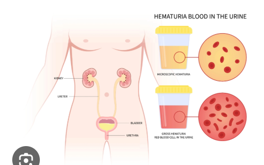 <p>What does hematuria mean?<br>→ Blood in urine</p><p>Name the 2 types of hematuria.<br>→ Gross and microscopic hematuria</p>