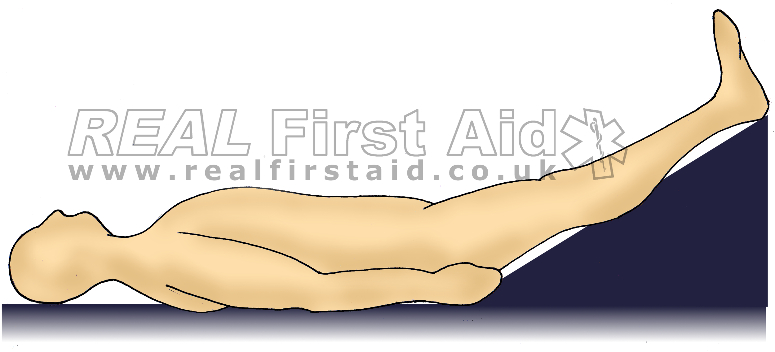 <p>D. place the pt in a supine position; this allows the pt 's legs to be raised above the level of their heart.</p>