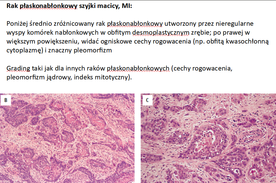 <p>B. Może tworzyć perły rogowe i mostki międzykomórkowe - bo płaskonabłonkowy</p>