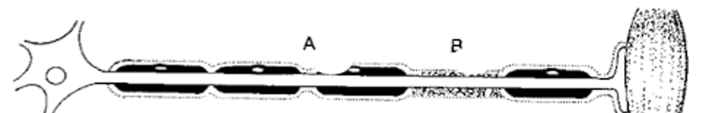 <p>-Injury to my myelin while the axon is intact</p><p>-Temporary conduction block</p><p>-Pt may complain of transient weakness</p>
