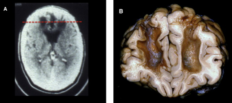<p><span style="font-family: "Times New Roman", serif; line-height: 107%;">Lobectomie&nbsp;: enlever parties les plus frontales du cerveau </span><span style="line-height: 107%;">—> </span><span style="font-family: "Times New Roman", serif; line-height: 107%;">réduction Sx psychiatriques (rend patients apathiques)</span></p><p></p>