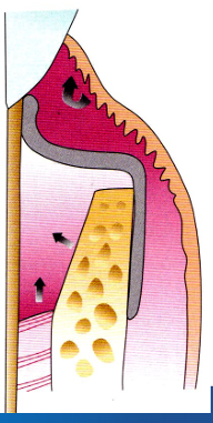 <p>-epithelial exclusion</p><p>-space creation (and maintenance)</p><p>-stabilization of clot</p><p>-complete coverage of sites</p>