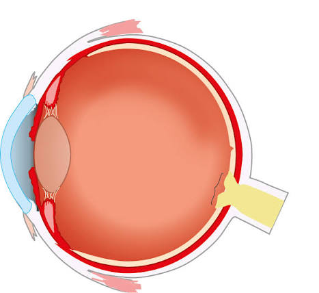 <p>Where are the cornea, iris, pupil, lens, retina, sclera, optic nerve, suspensory ligaments and ciliary muscles located on this diagram?</p>