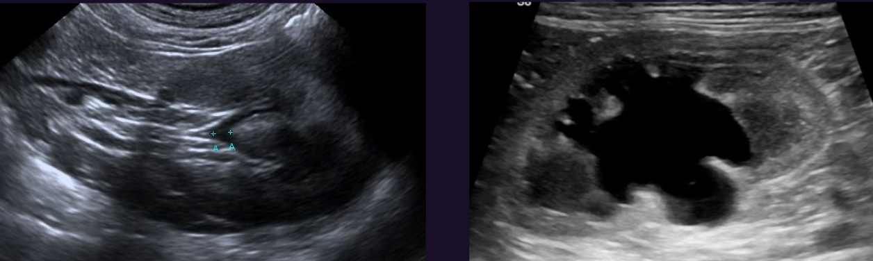<p>What changes of kidney are seen in this ultrasound</p>
