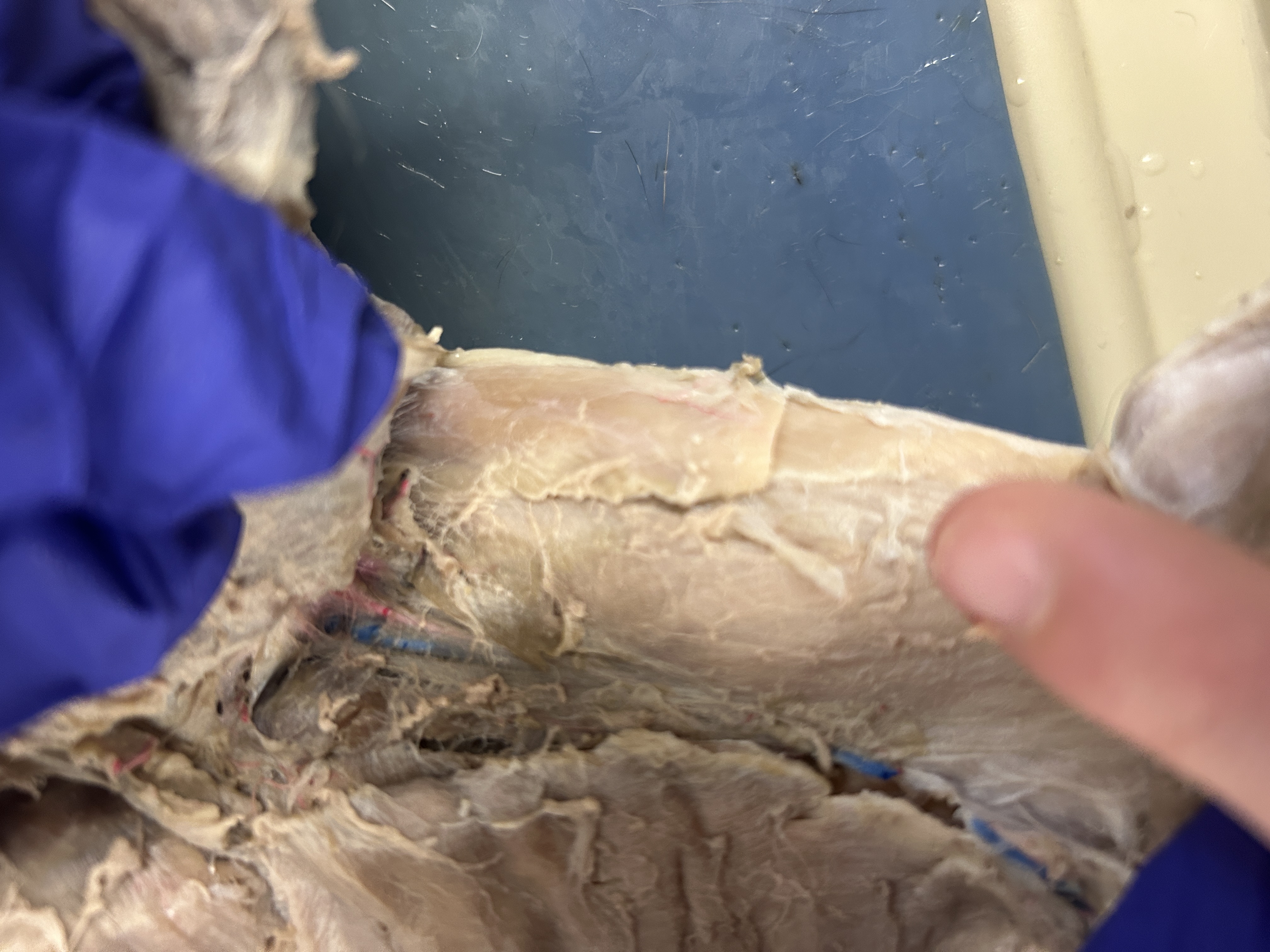 <p>Rectus Femoris(Middle under sartorius)</p>