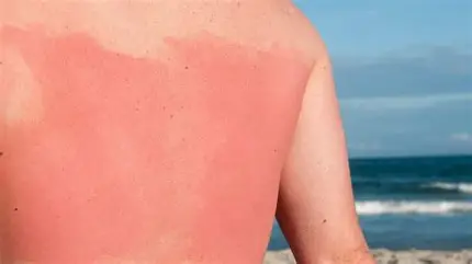 <p>Classification this burn is a</p>