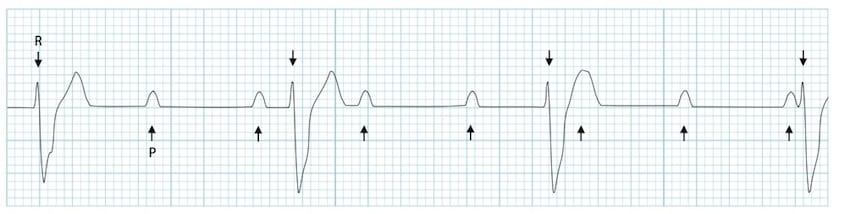 <p>Third degree heart block </p>