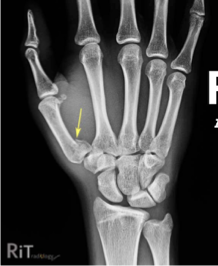 <p>What fracture is shown in the image?</p>