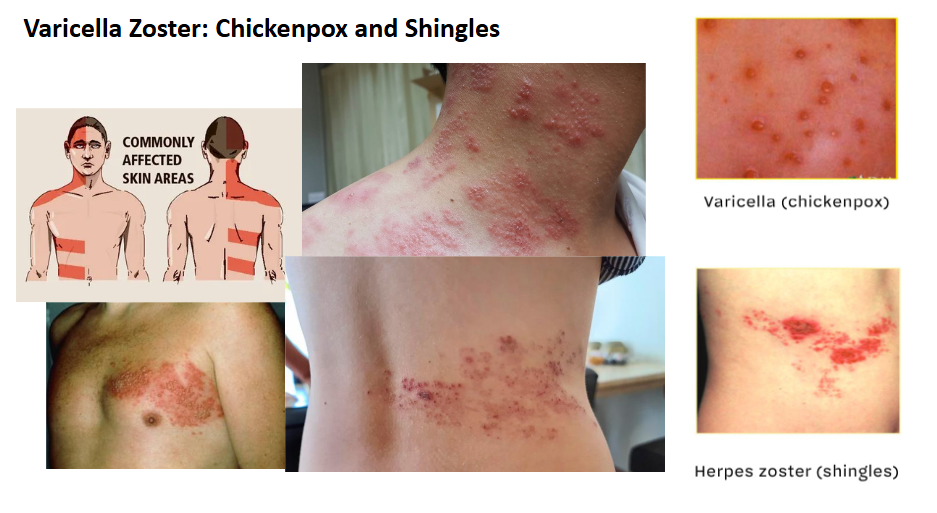 <p>Varicella Zoster: Chickenpox and Shingles</p>