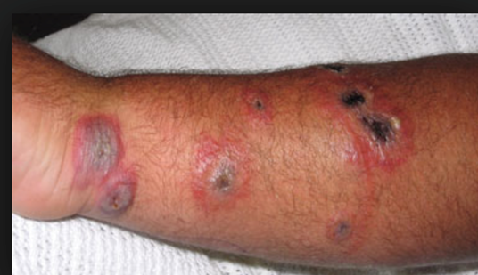 <p>Causative Agent: Bacillus anthracis (Endospores entering openings in the skin)<br>Symptoms/Signs: 20% cases are fatal; Necrotic sores</p>