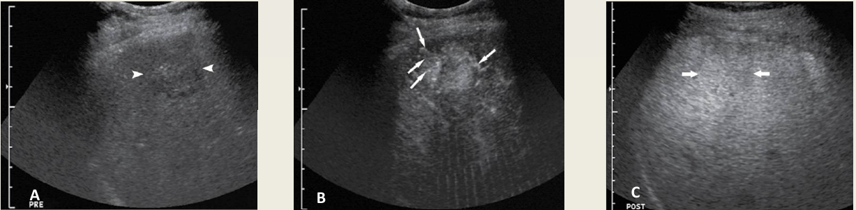 <p>what lesion is this on CEU?</p>