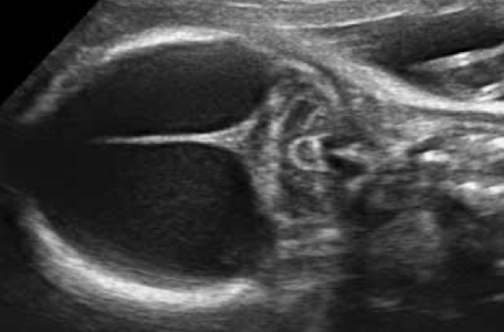 <ul><li><p>brainstem, cerebellum, cisterna magna unaffected </p></li><li><p>lacking a mantle or rim of cerebral brain tissue </p></li></ul><p></p>