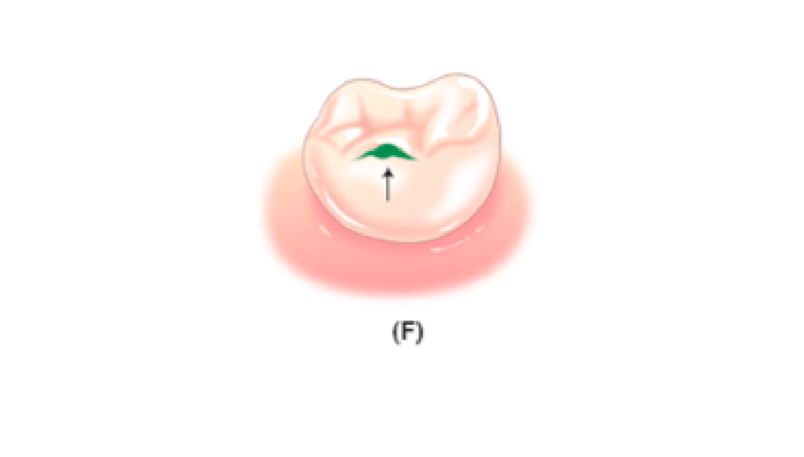 <p>Incisal edge of anterior teeth or cusp tips of posterior teeth that have been worn away due to abrasion ( wearing away) . usually not always caused by grinding of teeth .</p>