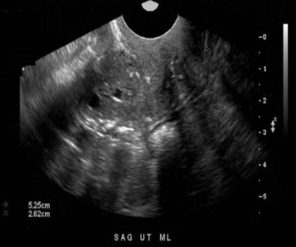 <p>A 65 yr old postmenopausal female presents with a recent history of spotting. She does take a regimen of Tamoxifen from a previous diagnosis of breast cancer but no other medications are used. Which of the following statements is true regarding the ultrasound findings?</p><p>A. The endometrium is thickened and heterogeneous which can be normal in a patient using Tamoxifen.</p><p>B. The uterus is atrophied and fibroids have formed causing the heterogeneous appearance.</p><p>C. The endometrium is thickened and heterogeneous which is abnormal and D&amp;C should be performed to rule out adenocarcinoma.</p><p>D. The endometrium is thickened and heterogeneous due to the presence of polyps.</p>