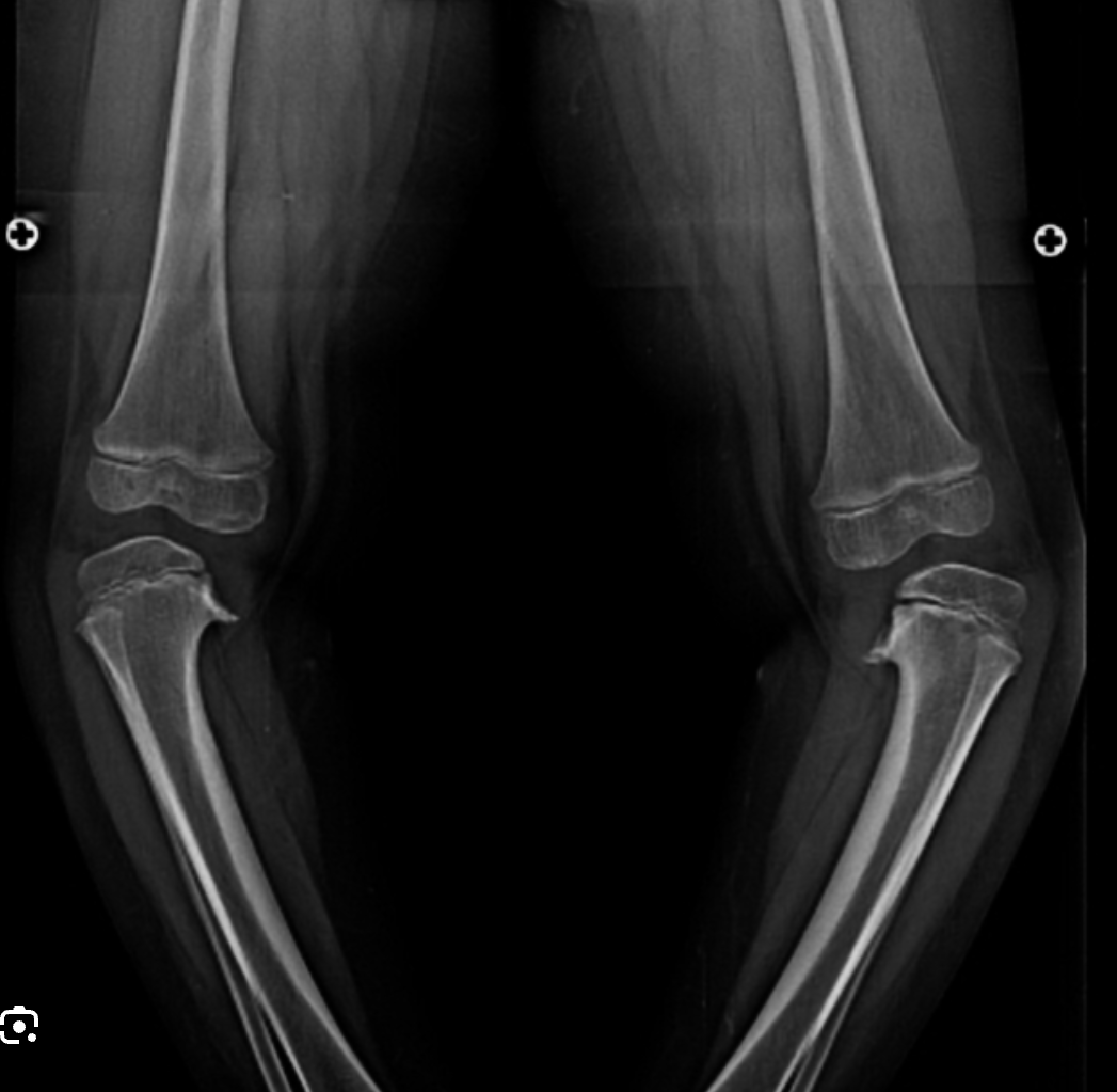 <p>AVN of the medial tibial condyle </p>