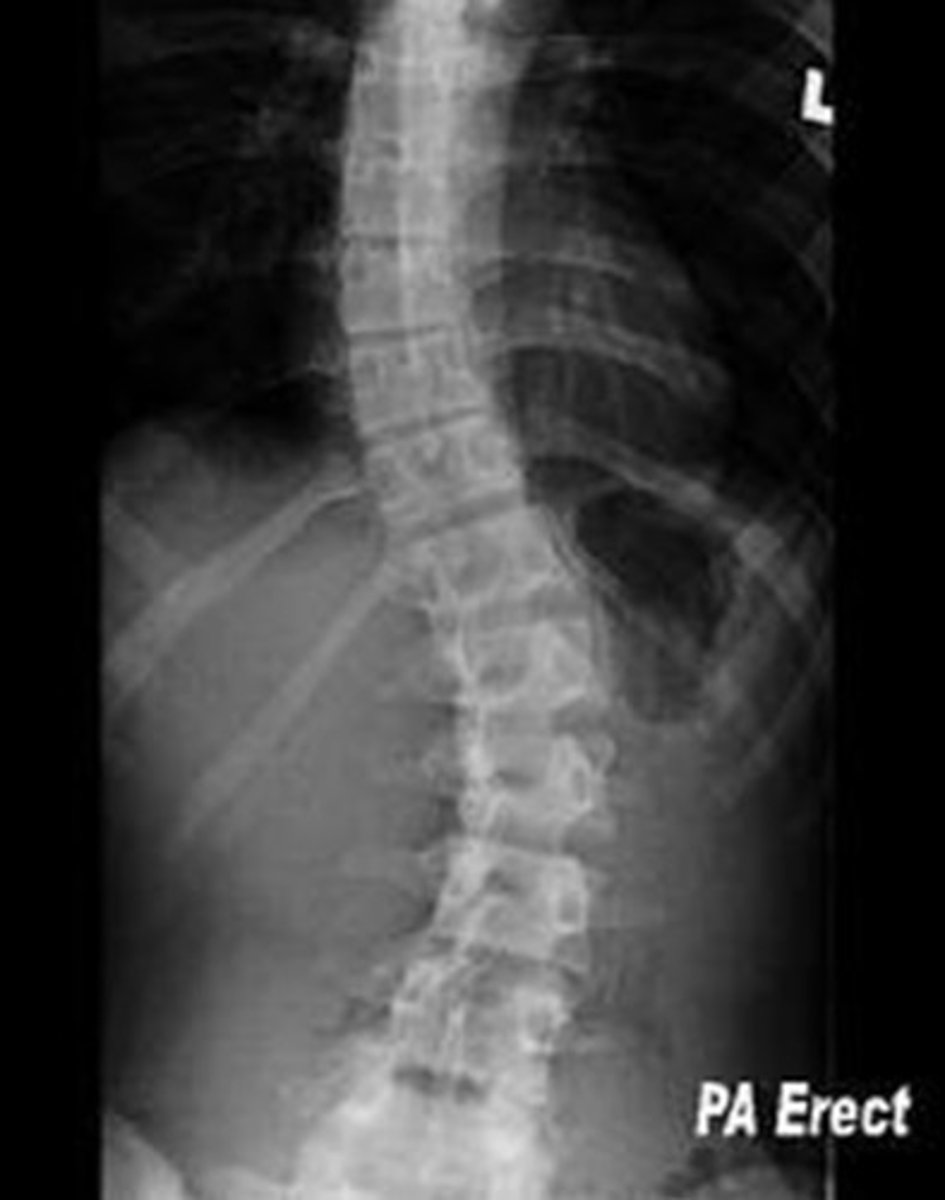 <p>scoliosis</p>