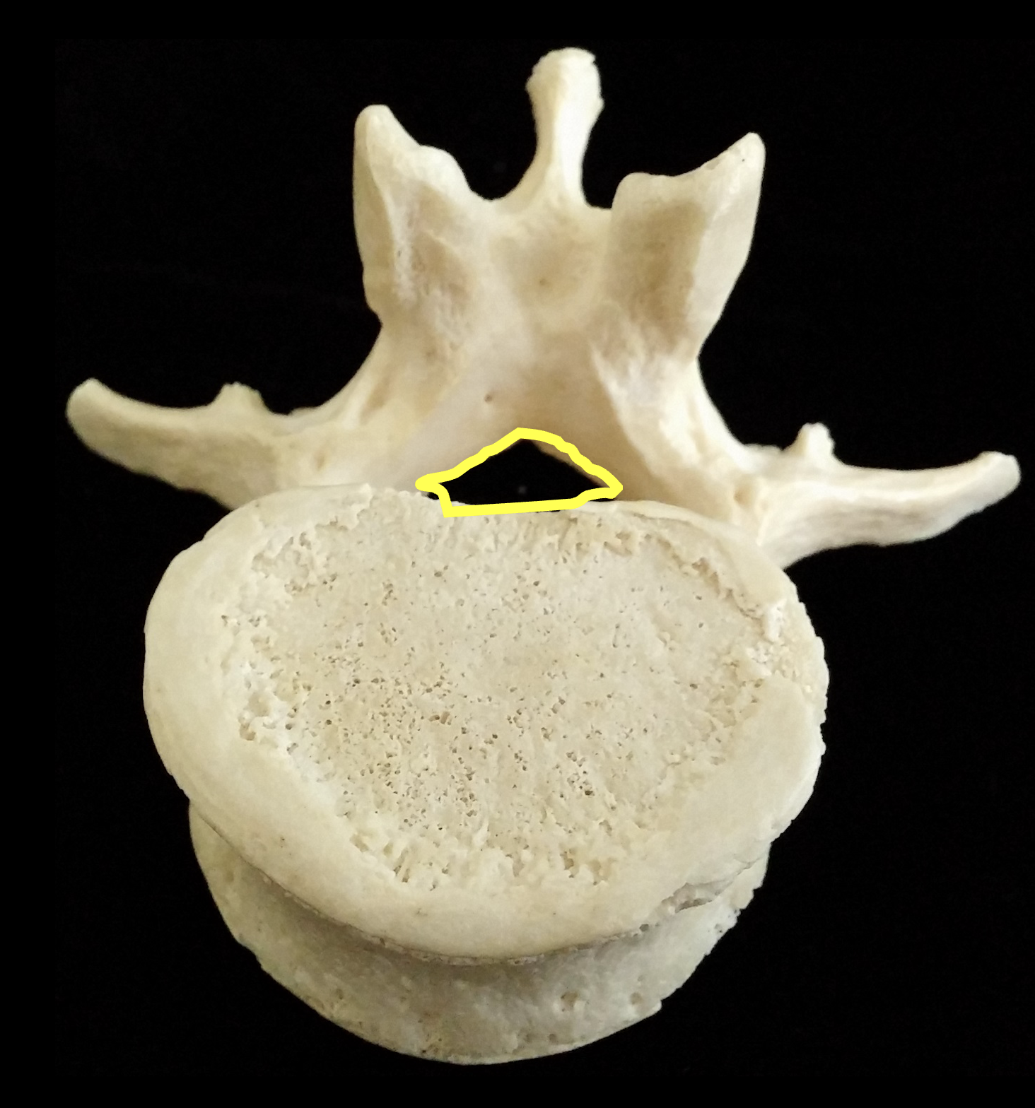 <p>What is the yellow region highlighted on the lumbar vertebrae?</p>