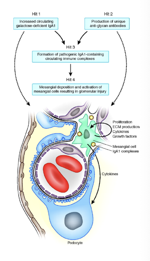 <ul><li><p>komt het vaakst voor </p></li><li><p>40-50% hematurie </p></li><li><p>typisch <3-5d na een BLWI → synpharyngitic hematuria </p></li><li><p>30-40% asymp / micro hematurie </p></li><li><p>nier biopt voor def diagnose → glom mesangial IgA stain op immunofluorscence </p><ul><li><p>IgA zit trapped in mesangium </p></li><li><p>diffuse mesangial cell proliferation and matrix expansion</p></li></ul></li><li><p>systemische variant → Henoch Schonplein Purpura = rode vlekjes op handen en voeten</p></li></ul><p></p>
