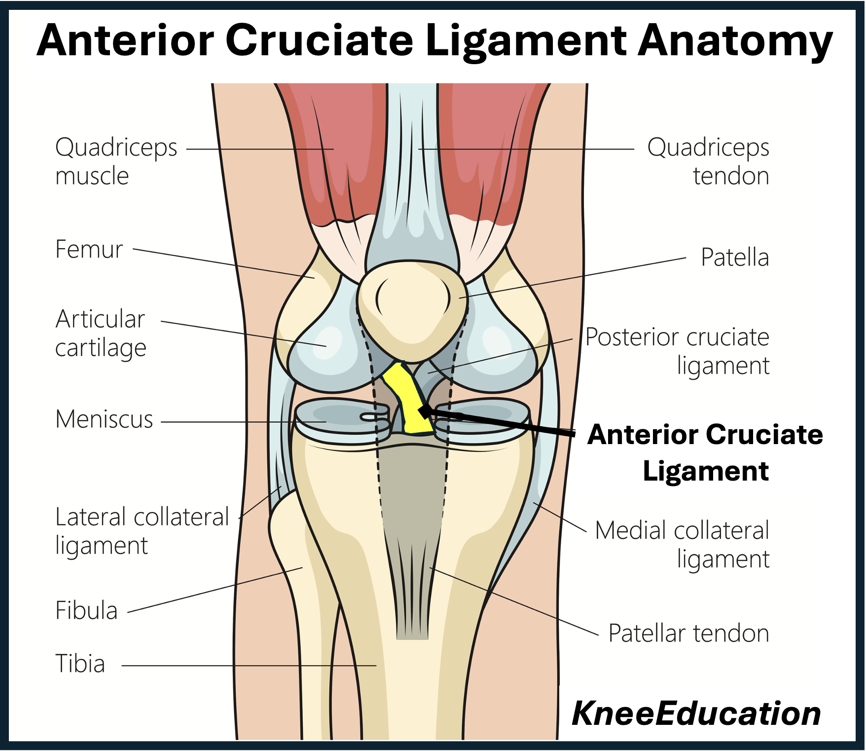 <ul><li><p>from anterior intercondylar region [superior, posterior, &amp; lateral] </p><ul><li><p>attach to lateral femoral femoral condyle [posteromedially]</p></li></ul></li><li><p>prevents posterior displacement of femur on tibia</p><ul><li><p>prevents hyperextension</p></li></ul></li><li><p>weaker than PCL</p></li><li><p>taut during extension</p></li><li><p>often injured in conjuction w/ tibial collateral ligament &amp; medial meniscus </p><ul><li><p><strong>unhappy triad</strong></p></li></ul></li></ul><p></p>