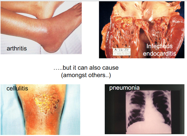 <p>S. aureus can also cause (amongst others)</p>