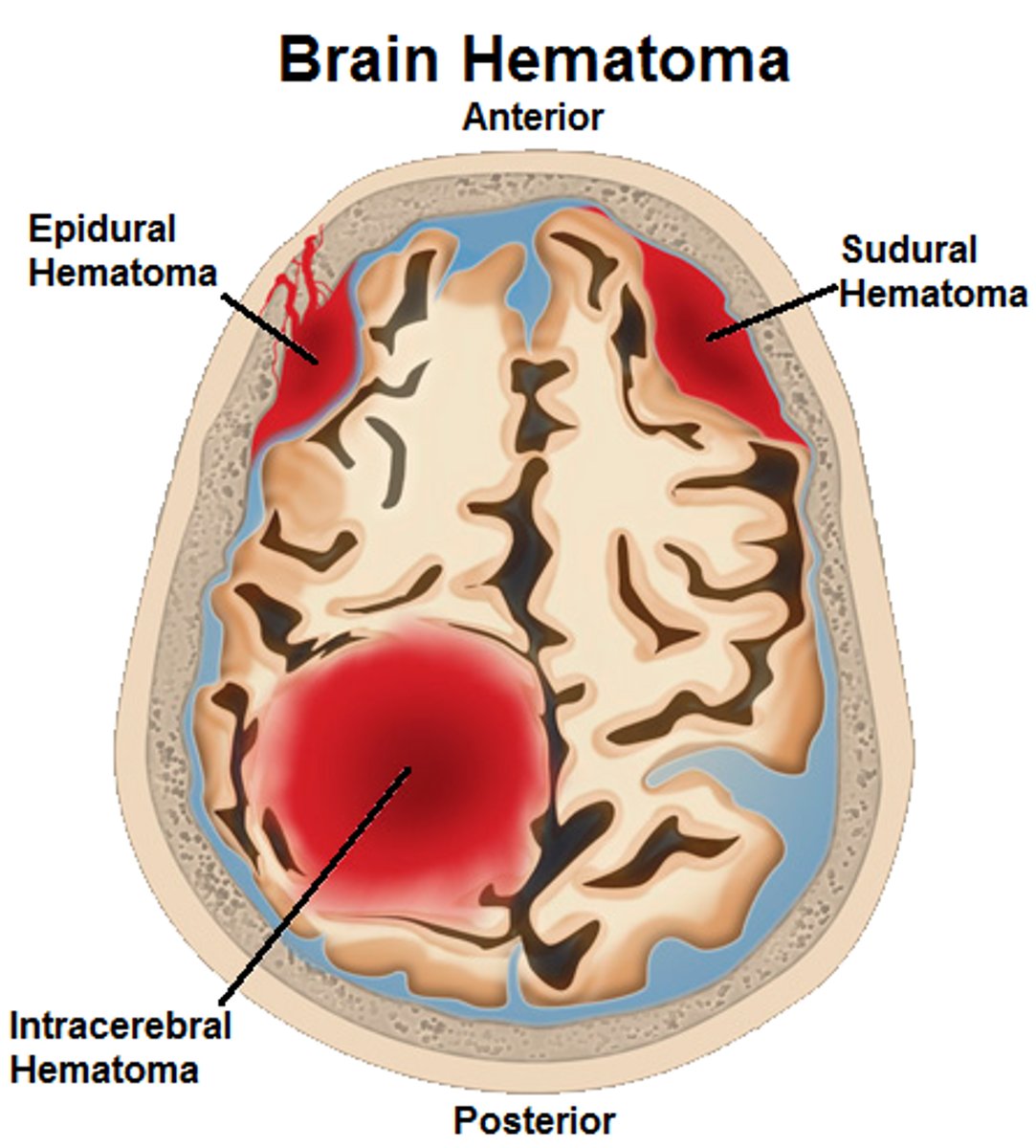 <p>Brain injury resulting in leakage of blood beneath/within dura layer</p>