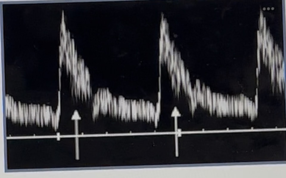 <p><span><span>What part of this spectral Doppler waveform is marked by the two white arrows?</span></span></p>