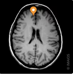 <p>Name the sulcus, modality, and plane</p>