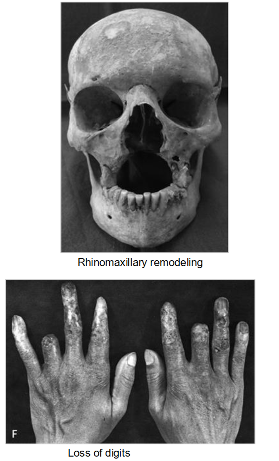 <p>Inflammatory or Infectious Disease Example: Leprosy (Hansen’s Disease)</p>