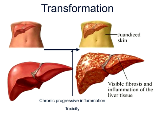 <p><strong>Liver cirrhosis</strong> is the end stage of chronic liver disease.</p><p>Characteristics include:</p><ul><li><p>Progressive fibrosis.</p></li><li><p>Replacement of healthy liver tissue with scar tissue.</p></li><li><p>Distortion of normal liver architecture.</p></li><li><p>Reduced liver volume.</p></li><li><p>Vascular remodeling leading to portal hypertension.</p></li></ul><p>Complications include:</p><ul><li><p>Liver failure</p></li><li><p>Portal hypertension</p></li><li><p>Ascites</p></li><li><p>Variceal bleeding</p></li><li><p>Hepatocellular carcinoma</p></li></ul><p></p>
