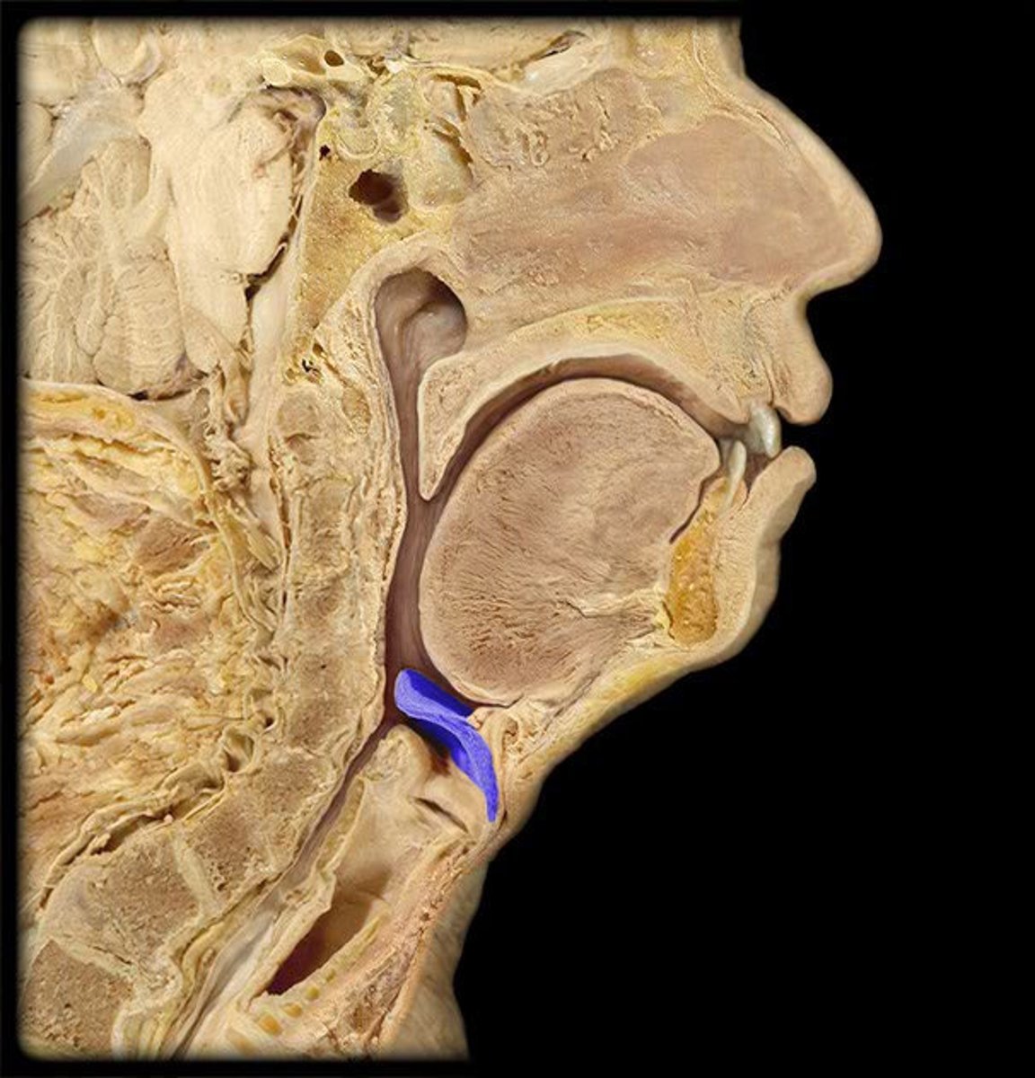 <p>trap door that covers larynx while swallowing; keeps you from choking</p>