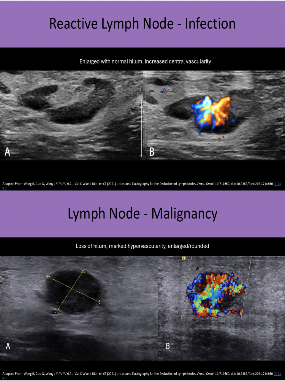 <p>C. malignancy, infection</p><p class="p1">An enlarged, rounded lymph node with loss of hilar definition = suspicious for underlying malignancy</p><p class="p1">An enlarged, oval lymph node with normal hilar characteristics = suspicious for underlying infection</p>