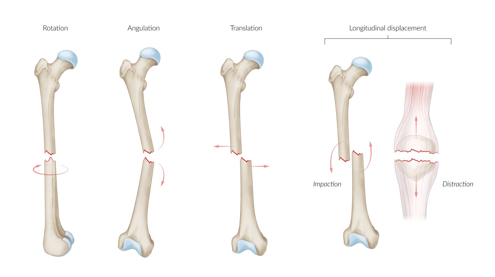 <p>Angulation: Angled axis</p><p>Translation: Lateral bone fragment displacement</p><p>Rotation: Around longitudinal axis</p><p>Longitudinal bone fragment displacement</p><ul><li><p>Distraction: Elongated</p></li><li><p>Impaction: Shortened</p></li></ul><p></p>