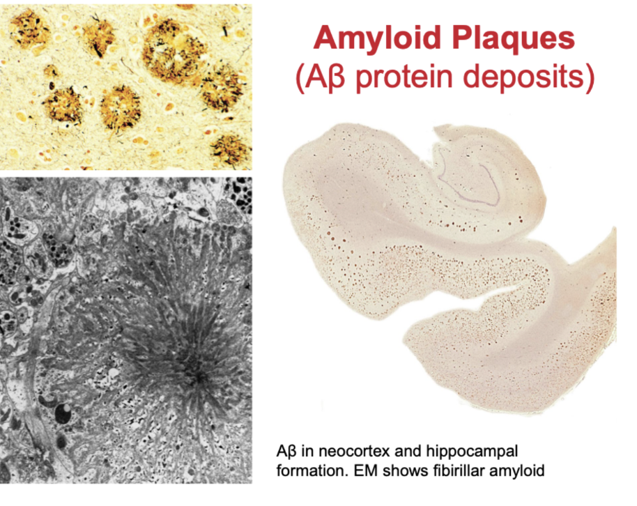 <p>Aβ protein deposits </p><ul><li><p>Aβ in neocortex and hippocampal formation- EM shows fibrillae amyloid</p></li></ul><p></p>