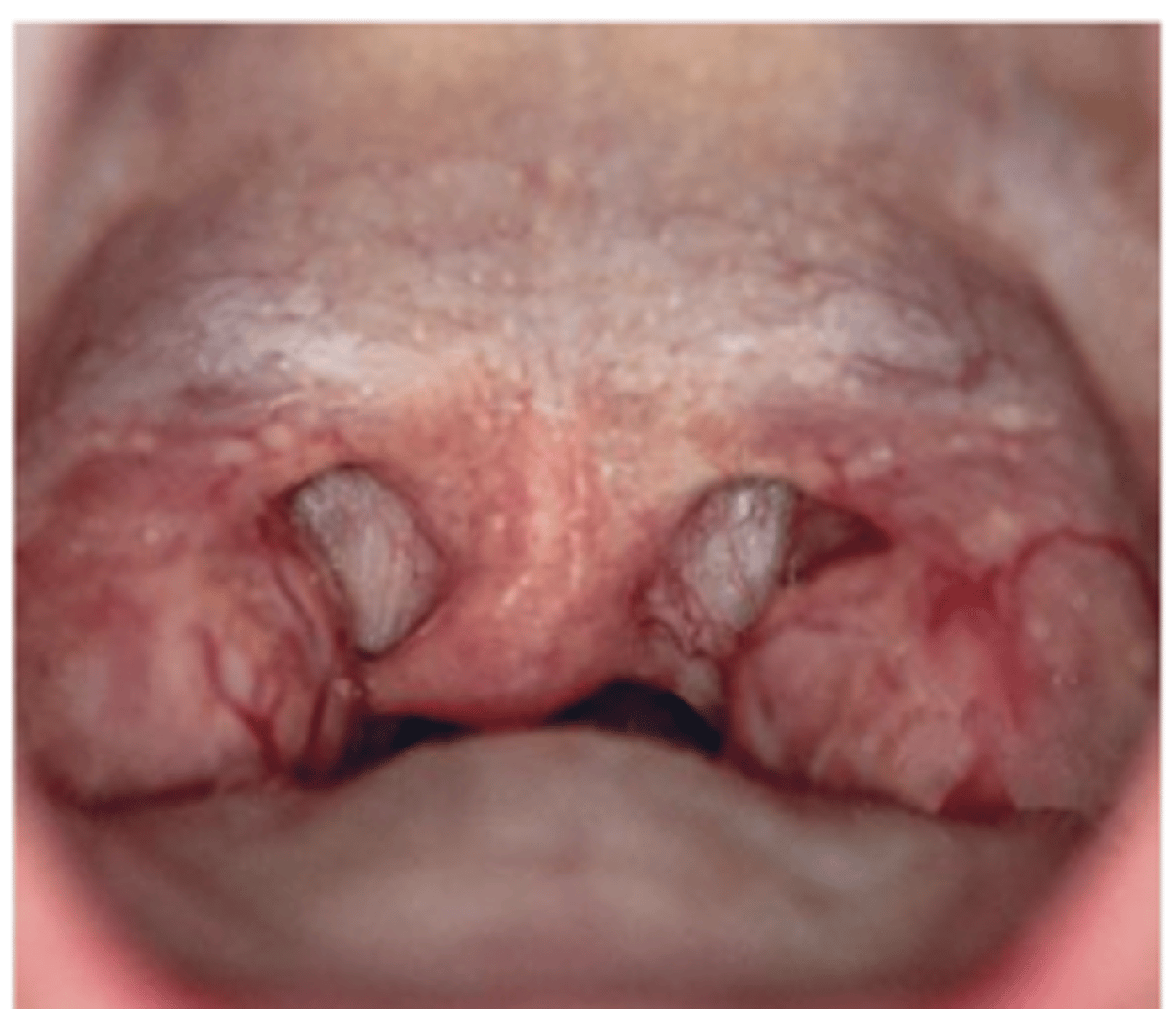 <p>Normal tonsils may be large without being infected, especially in children. They may protrude medially beyond the pillars and even to the midline. Here they slightly obscure the pharynx. Their color is pink.</p>