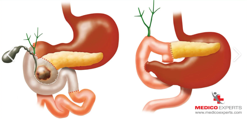 <p>The surgical procedure described as a "partial pancreatectomy with en bloc excision of the distal stomach, common bile duct, and duodenum</p>
