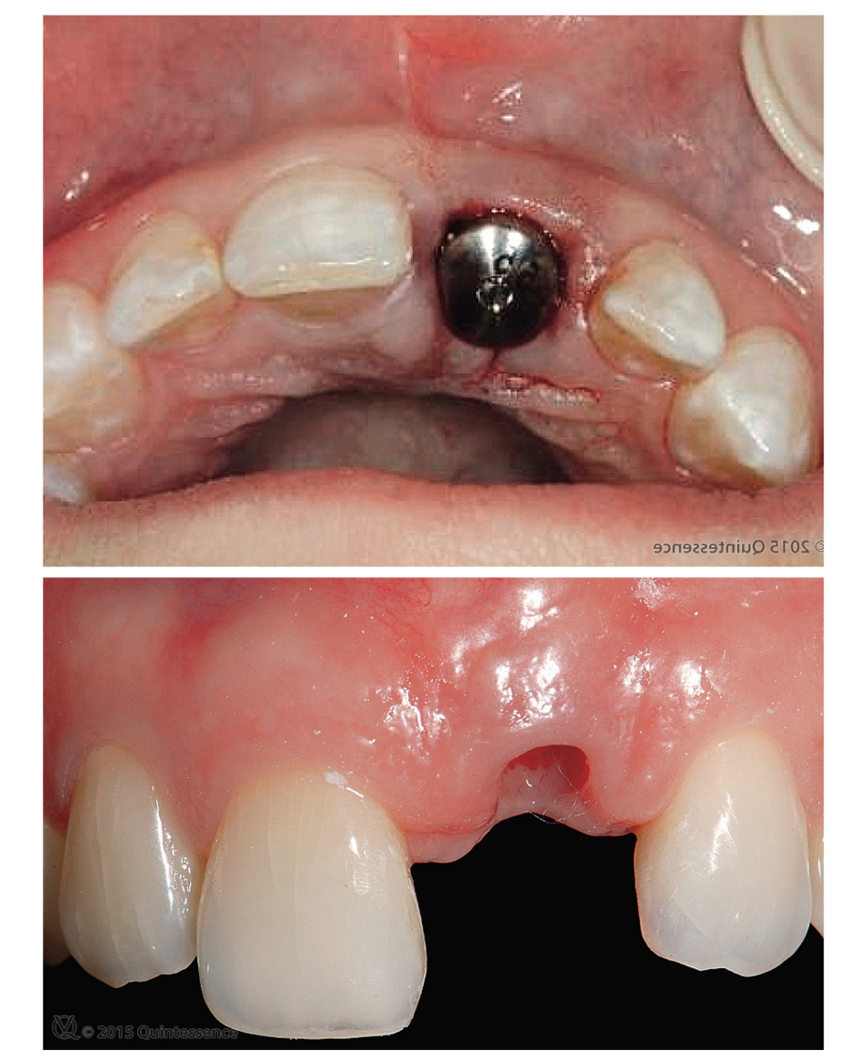 <p>anatomical or non-anatomical healing abutment</p>