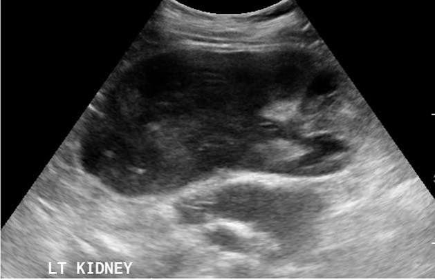 <ul><li><p>enlarged, hypo kidneys </p></li><li><p>may simulate renal cyst without enhancement </p></li><li><p>very hypo, poorly defined margins </p><ul><li><p>can be confused fro cyst</p></li></ul></li></ul><p></p>