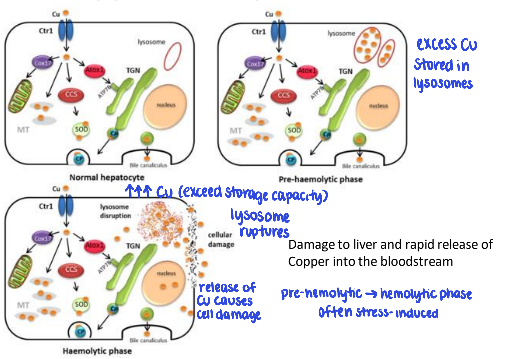 <ul><li><p>pre-hemolytic phase: excess copper stored in lysosomes</p></li><li><p>hemolytic phase: ↑↑ copper → lysosome ruptures</p></li><li><p>release of copper causes cell damage &amp; rapid release into bloodstream</p><ul><li><p>redox cycling, oxidative stress, &amp; lipid peroxidation → mitochondrial + cellular damage</p></li><li><p>release of hepatic copper to RBCs &amp; kidneys leads to severe hemolysis + renal necrosis, also via generation of ROS</p></li></ul></li><li><p>pre-hemolytic → hemolytic phase often stress-induced</p></li></ul><p></p>