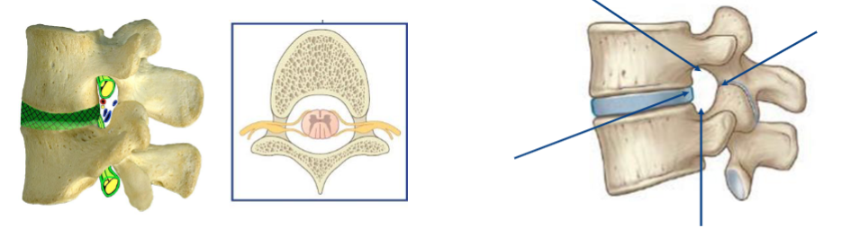 <ul><li><p>a foramen created from to vertebrae stacked together</p></li><li><p>inferior notch of upper vertebra + superior notch of loer vertebra = foramen</p></li><li><p>spinal nerve roots leave through these foramen</p></li></ul><p></p>